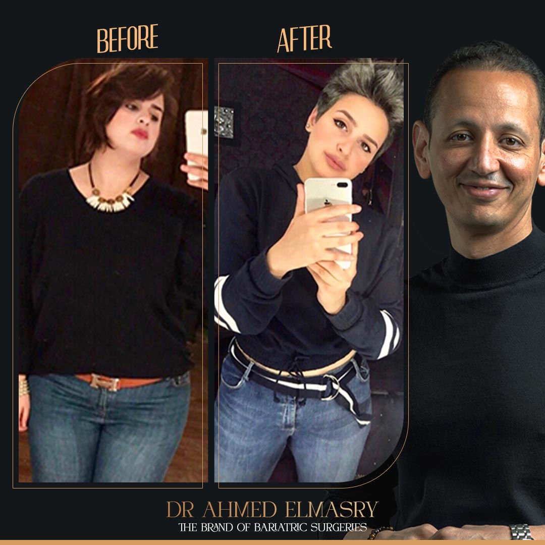 تجارب تكميم المعدة